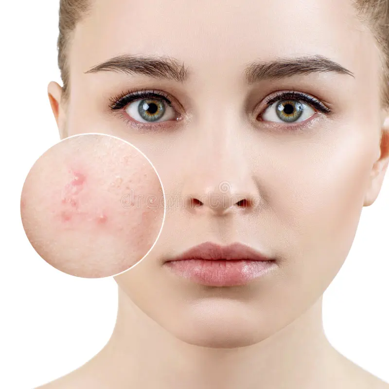 Acne Treatment