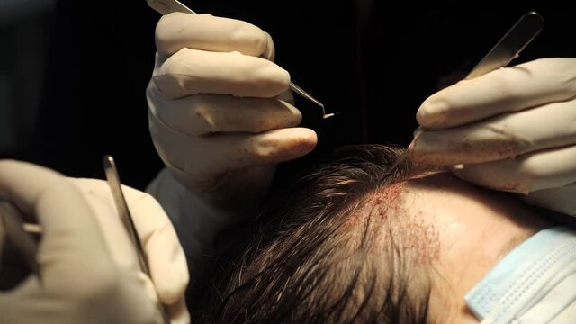 Hair Transplant